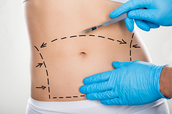 Abdominoplastik Böblingen